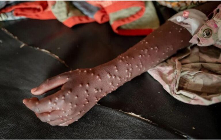 Le Directeur de la prévention alerte : «Le virus du Mpox circule à Dakar…»