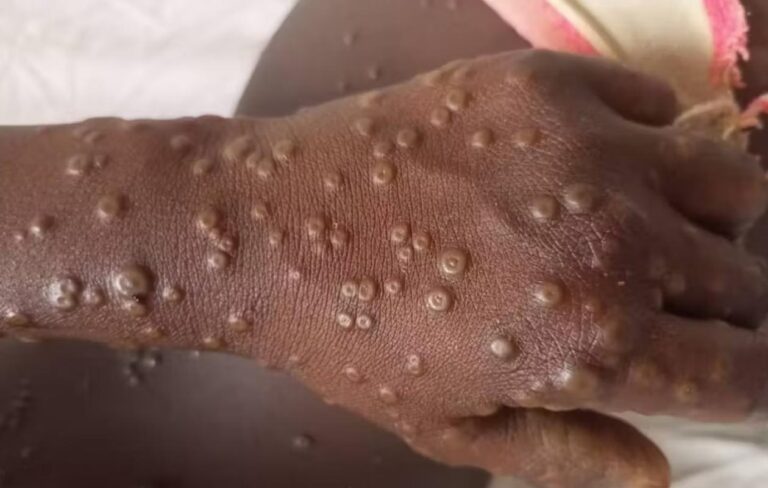 Variole du Singe (Mpox) : Le décompte passe à 4 cas positifs et 38 cas contacts au Sénégal